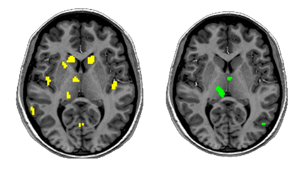 Larger brain activity on the left and smaller brain activity on the right